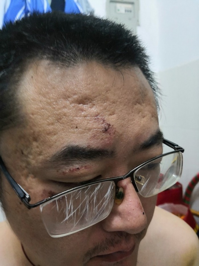 胡正军遭到警察殴打，导致身上多处受伤。（受访者提供）.jpg